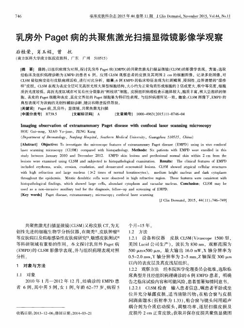 乳房外Paget病的共聚焦激光扫描显微镜影像学观察