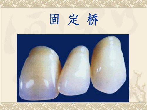 固定桥