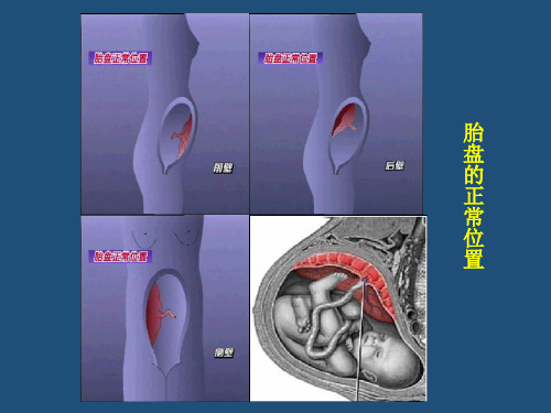 妇产科学精品课件前置胎盘PPT课件