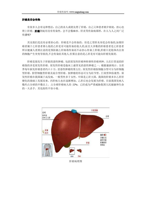 肝癌传染吗