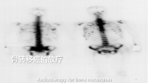 骨转移癌放射治疗ppt课件