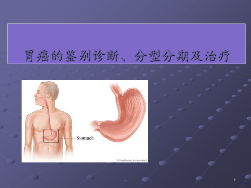 胃癌的鉴别诊断及分型治疗ppt课件