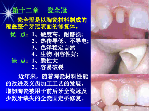瓷全冠 瓷全冠是以陶瓷材料制成的覆盖整个牙冠表面的修复