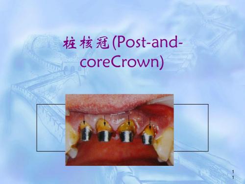 桩核冠 贴面[优质ppt]