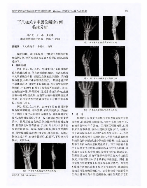 下尺桡关节半脱位漏诊2例临床分析