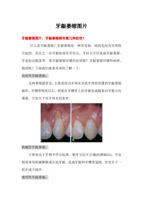 牙龈萎缩图片