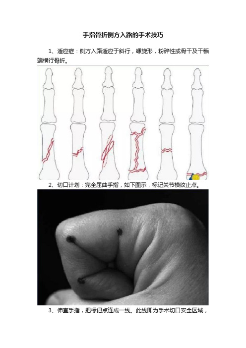 手指骨折侧方入路的手术技巧