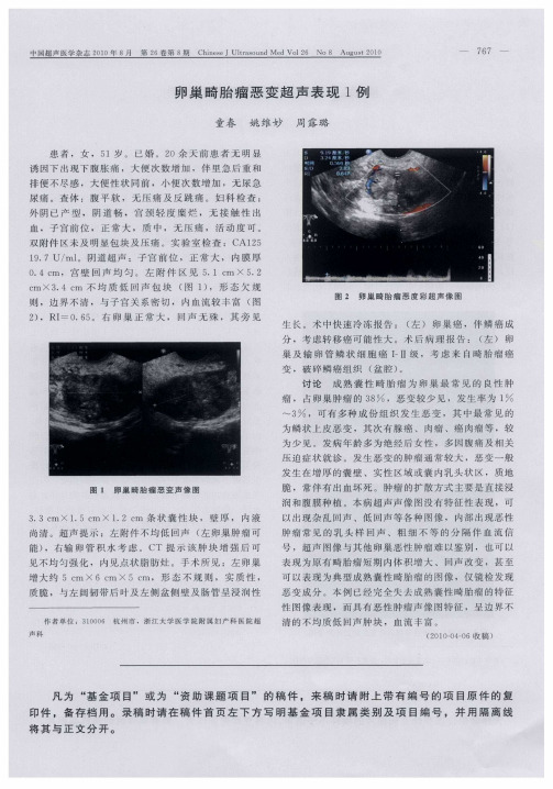 卵巢畸胎瘤恶变超声表现1例