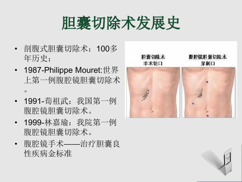 经脐单孔腹腔镜下胆囊切除术_PPT课件