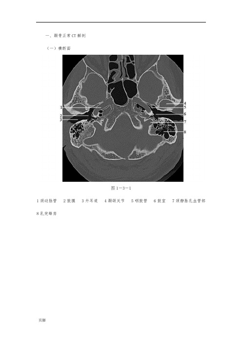 颞骨正常CT解剖(附图)