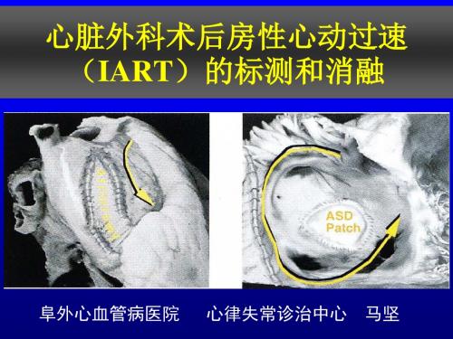 2015心脏外科术后房速的标测和消融-edited by Will Guo 20150122