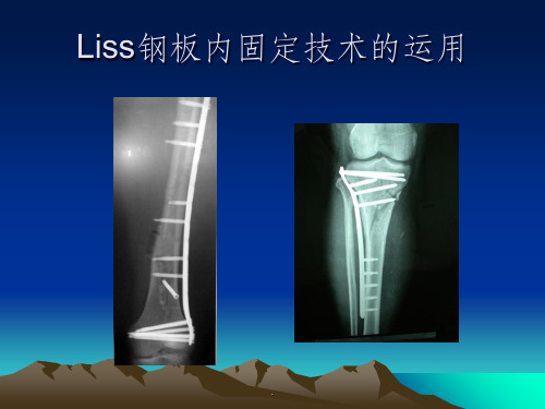 Liss钢板内固定技术的运用