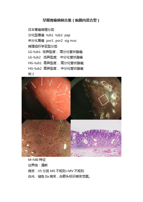 早期胃癌病例合集（黏膜内混合型）