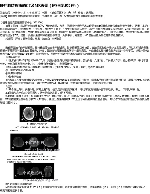 肝癌脑转移瘤的CT及MR表现(附8例影像分析)