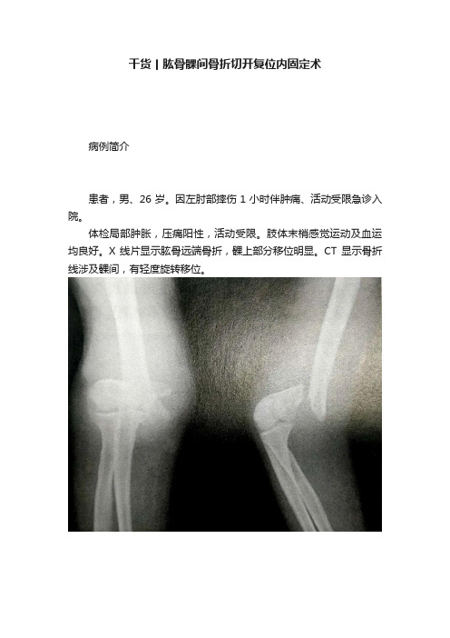 干货丨肱骨髁间骨折切开复位内固定术