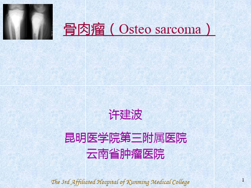 骨肉瘤(Osteosarcoma)-PPT课件