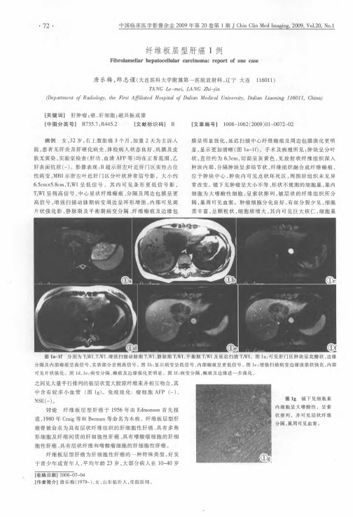 纤维板层型肝癌1例