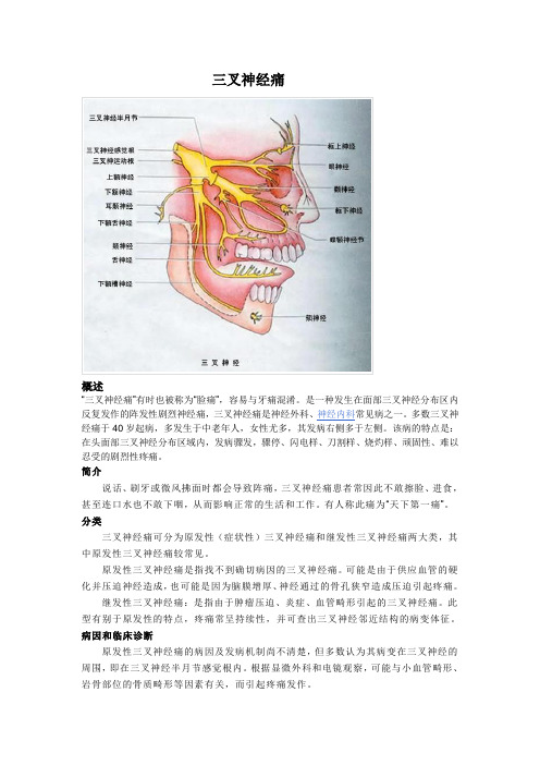 三叉神经痛