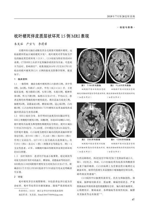 枕叶梗死伴皮质层状坏死15例MRI表现