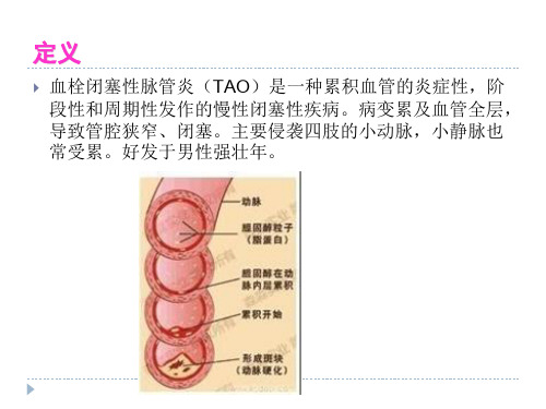 PPT医学课件血栓闭塞性脉管炎护理讲义