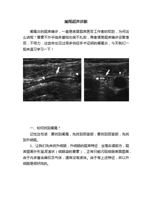 阑尾超声诊断