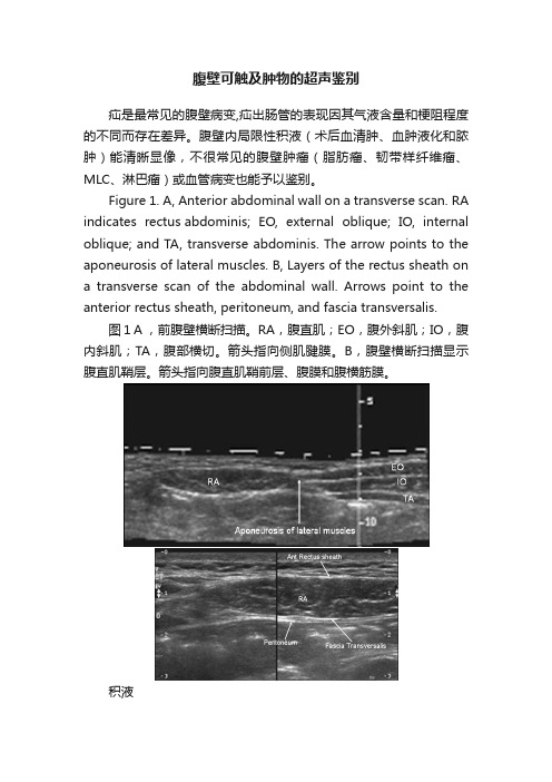 腹壁可触及肿物的超声鉴别