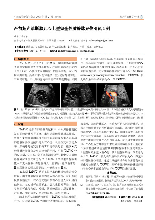 产前超声诊断胎儿心上型完全性肺静脉异位引流1例