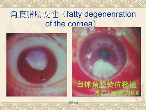 《角膜脂肪变性》PPT课件