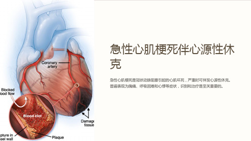 急性心肌梗死伴心源性休克