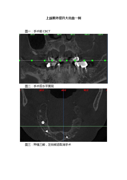 上颌窦外提升大出血一例