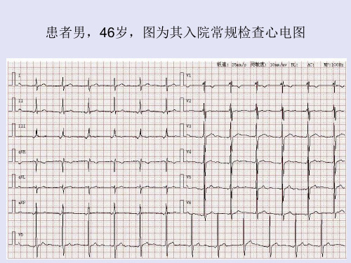 心电图二
