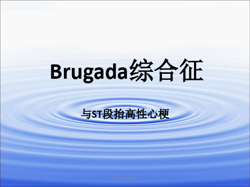 Brugada综合征ppt课件