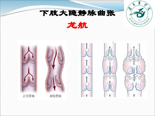 下肢大隐静脉曲张ppt课件