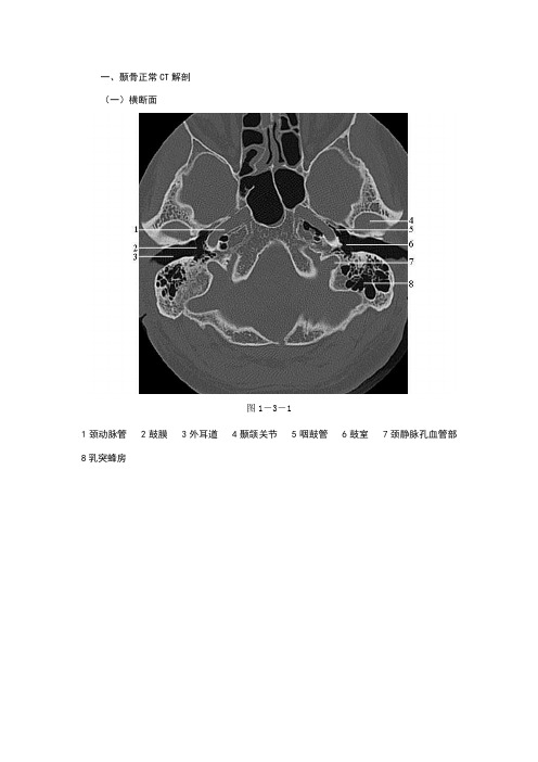 颞骨正常CT解剖(附图)