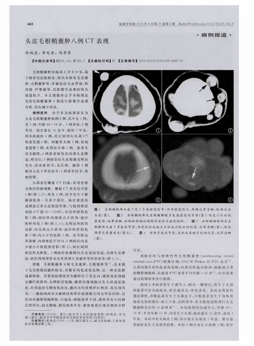 头皮毛根鞘囊肿八例CT表现