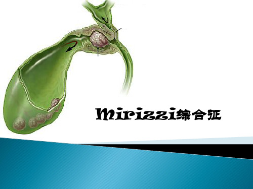 mirrizi综合征