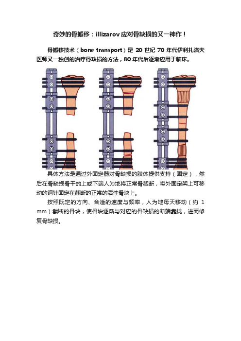 奇妙的骨搬移：illizarov应对骨缺损的又一神作！