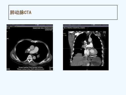 肺栓塞CT诊断