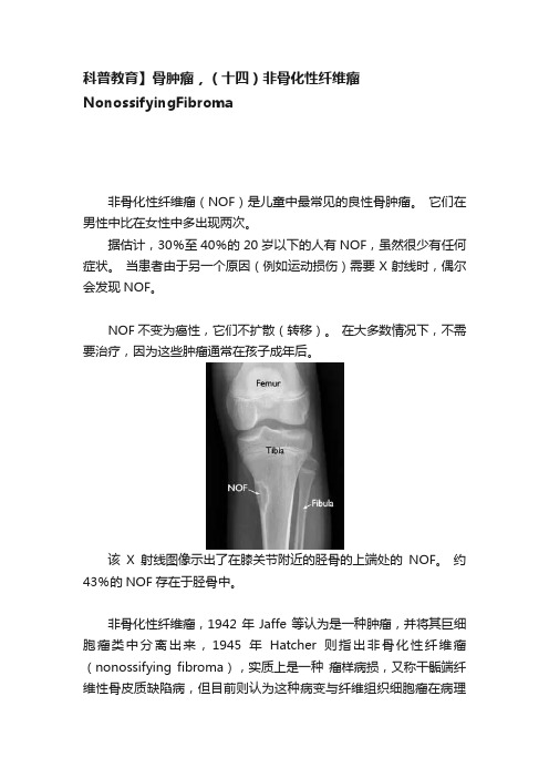 科普教育】骨肿瘤，（十四）非骨化性纤维瘤NonossifyingFibroma