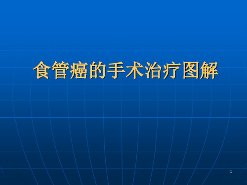 食管癌的手术治疗图解(课堂PPT)