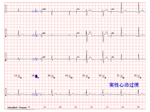 心电图常见正常和异常心电图图谱ppt课件