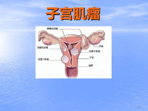 子宫肌瘤(演示)PPT课件