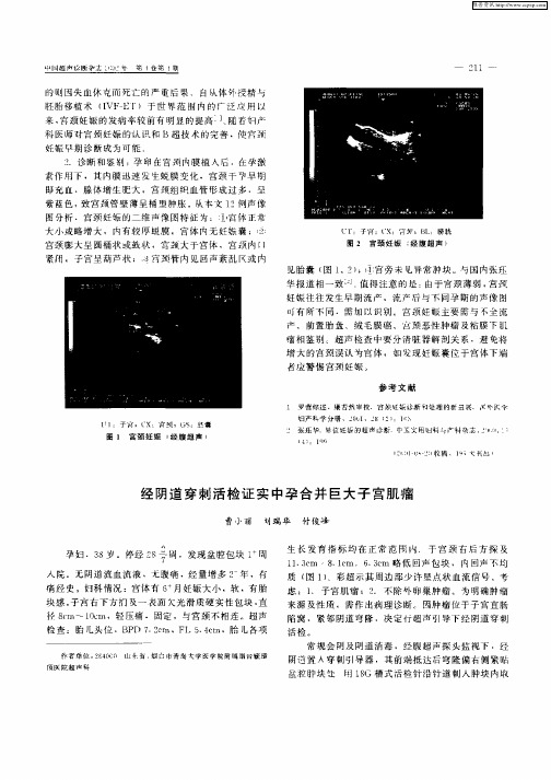 经阴道穿刺活检证实中孕合并巨大子宫肌瘤