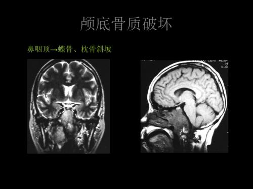 颅底骨质破坏2-ppt课件 24页PPT