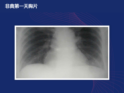 急性肺损伤和急性呼吸窘迫