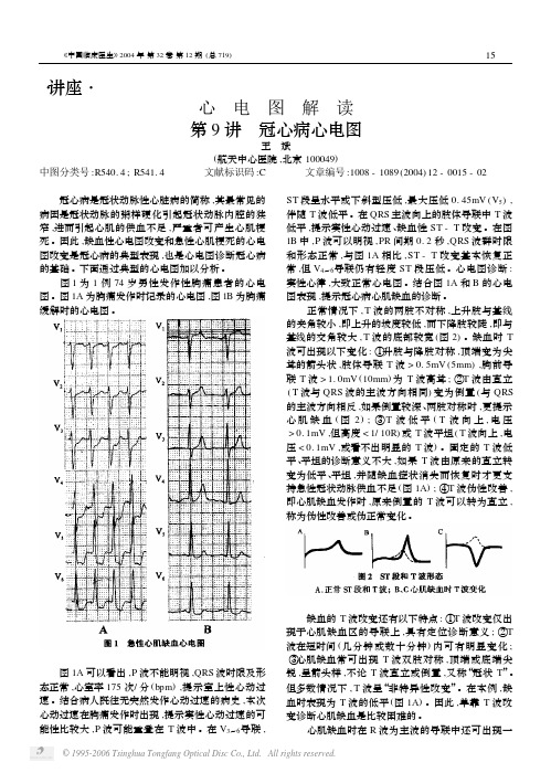 心电图解读 第9讲 冠心病心电图