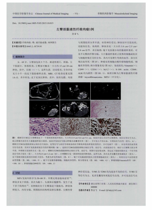 左臀部黏液性纤维肉瘤1例