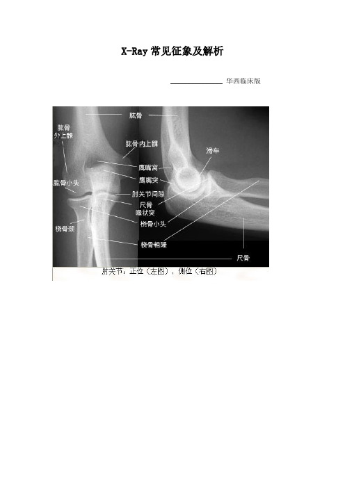 5、X-Ray常见征象及解析(华西版)