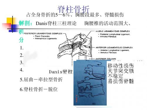 脊柱骨折