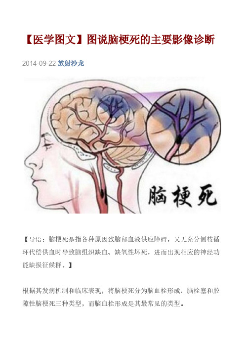 【免费下载】医学图文图说脑梗死的主要影像诊断